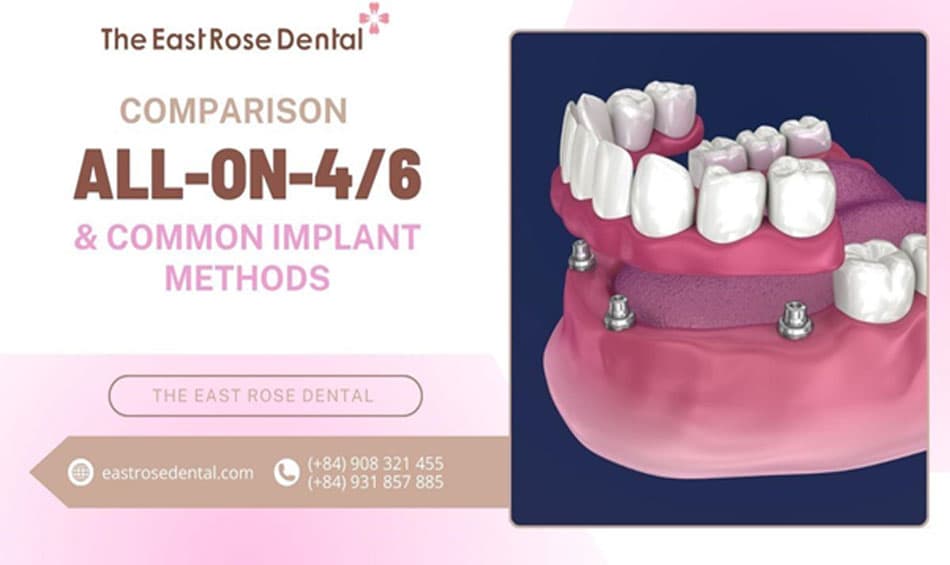 Comparison between All-on-4/6 and common implant methods