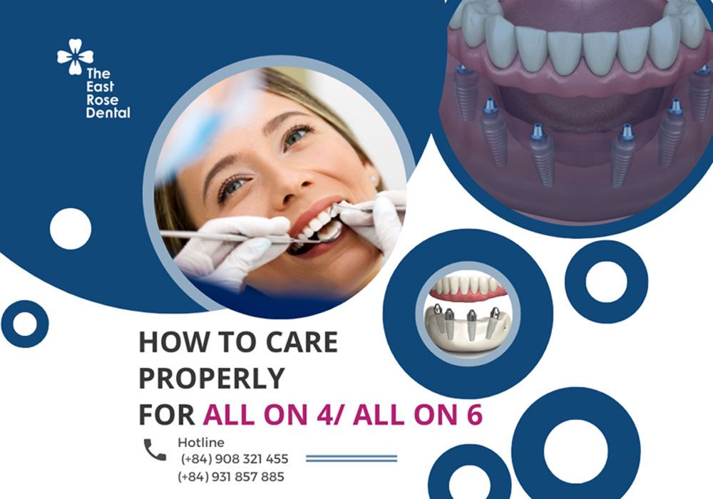 How to properly care for the All on 4 / All on 6