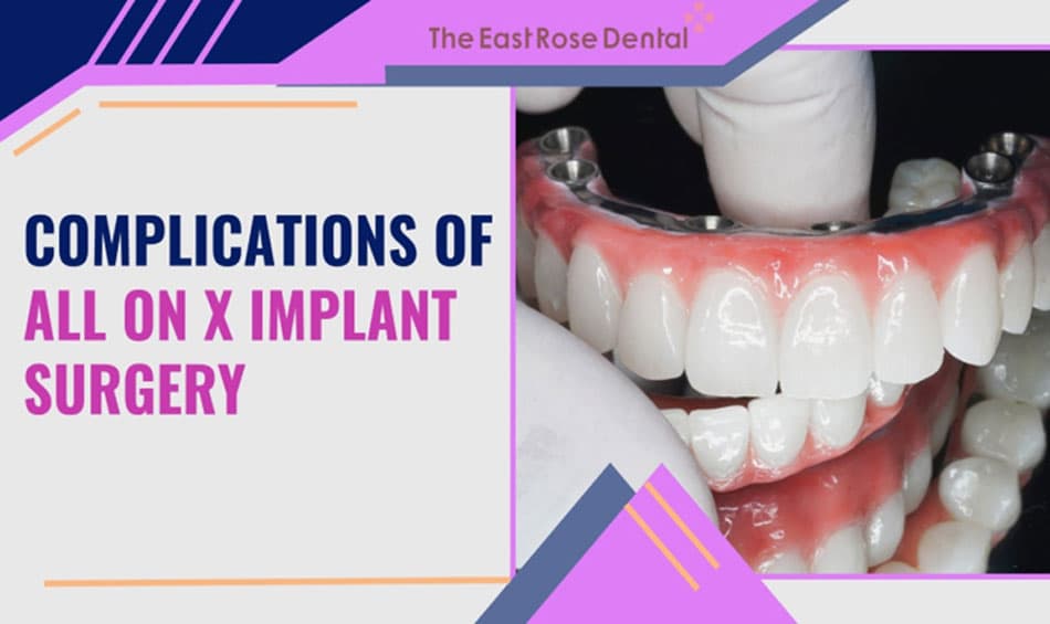 Possible Complications of All On X Full-Mouth Implant Placement