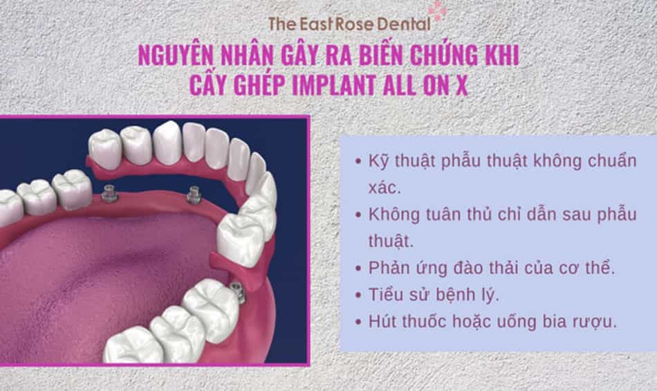 Nguyên nhân gây ra biến chứng khi cấy ghép implant All On X