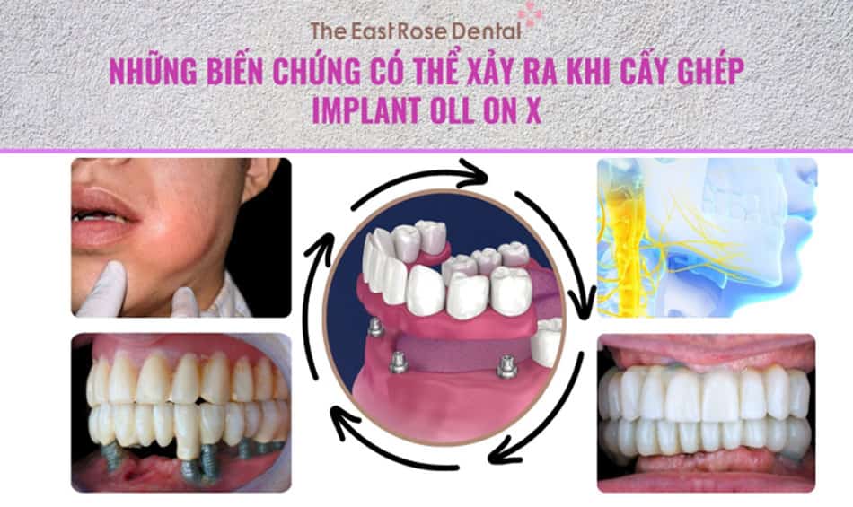 Những biến chứng phổ biến khi cấy ghép implant toàn hàm All On X (hình minh hoạ)