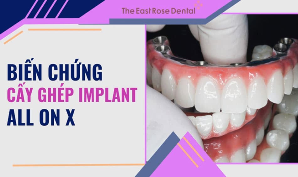 Biến chứng có thể xảy ra khi cấy ghép implant toàn hàm All On X