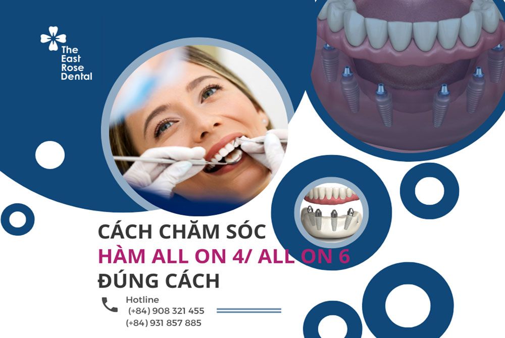 Chăm sóc hàm implant All on 4 / All on 6 đúng cách