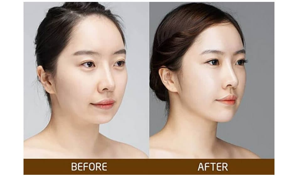 Cằm lẹm là gì? Nhân tướng học của người cằm lẹm