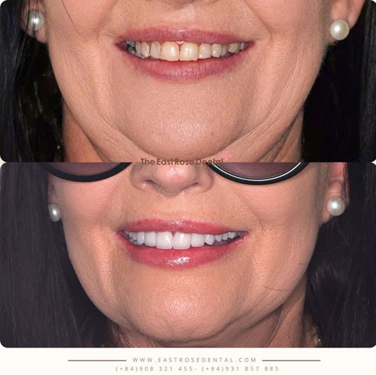 Crown results at The East Rose Dental Clinic