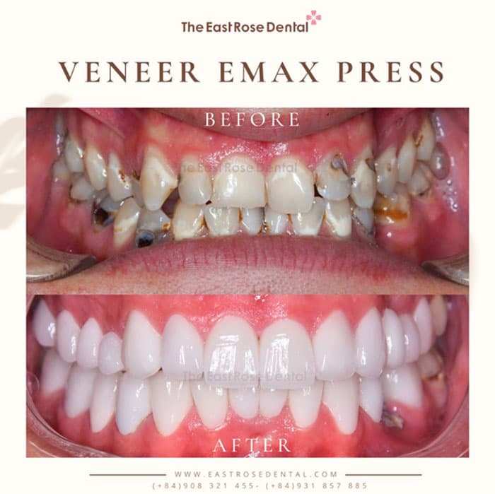 Dán sứ Veneer là giải pháp tuyệt vời giúp răng đẹp chuẩn y khoa