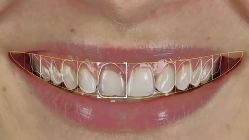 Kích thước và khoảng cách từng chiếc răng cần phải cân đối