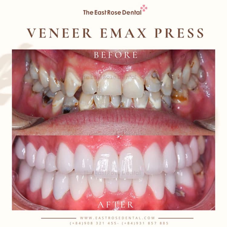 Veneer bonding is an excellent solution for achieving clinically perfect teeth