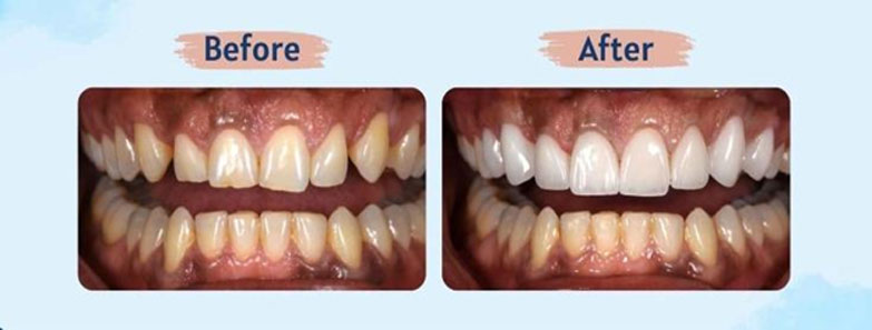 Tư vấn chi tiết về dịch vụ dán sứ siêu mỏng Veneer Emax Press và tận hưởng nụ cười tỏa sáng như ngôi sao