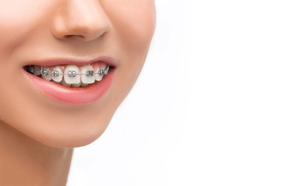 2- Niềng răng mắc cài mang đến cho bạn nụ cười đẹp, tự tin, và khắc phục được nhiều khuyết điểm