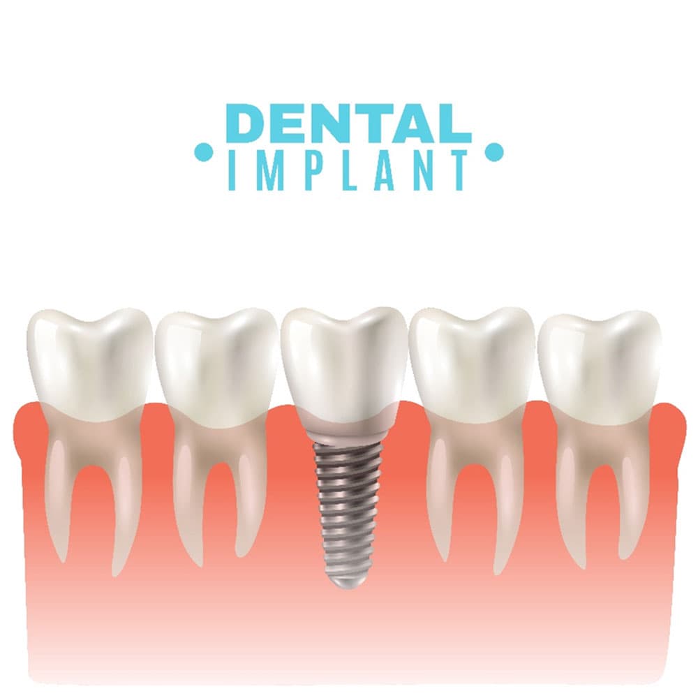 Các loại implant tại Nha Khoa Hoa Hồng Phương Đông - Chọn loại nào phù hợp?