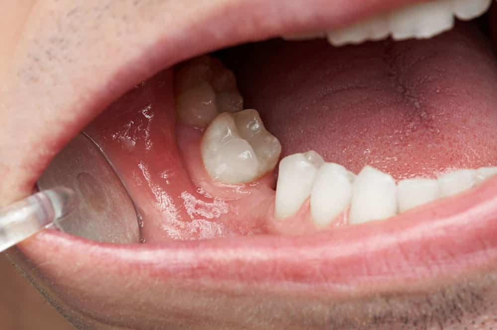 Lost Molar Teeth And Things You Need To Know