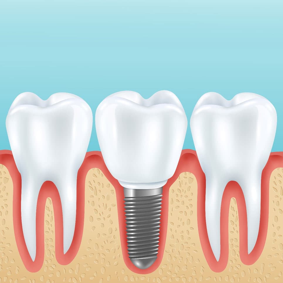 Trụ implant nobel - thương hiệu hàng đầu được chuyên gia tin dùng