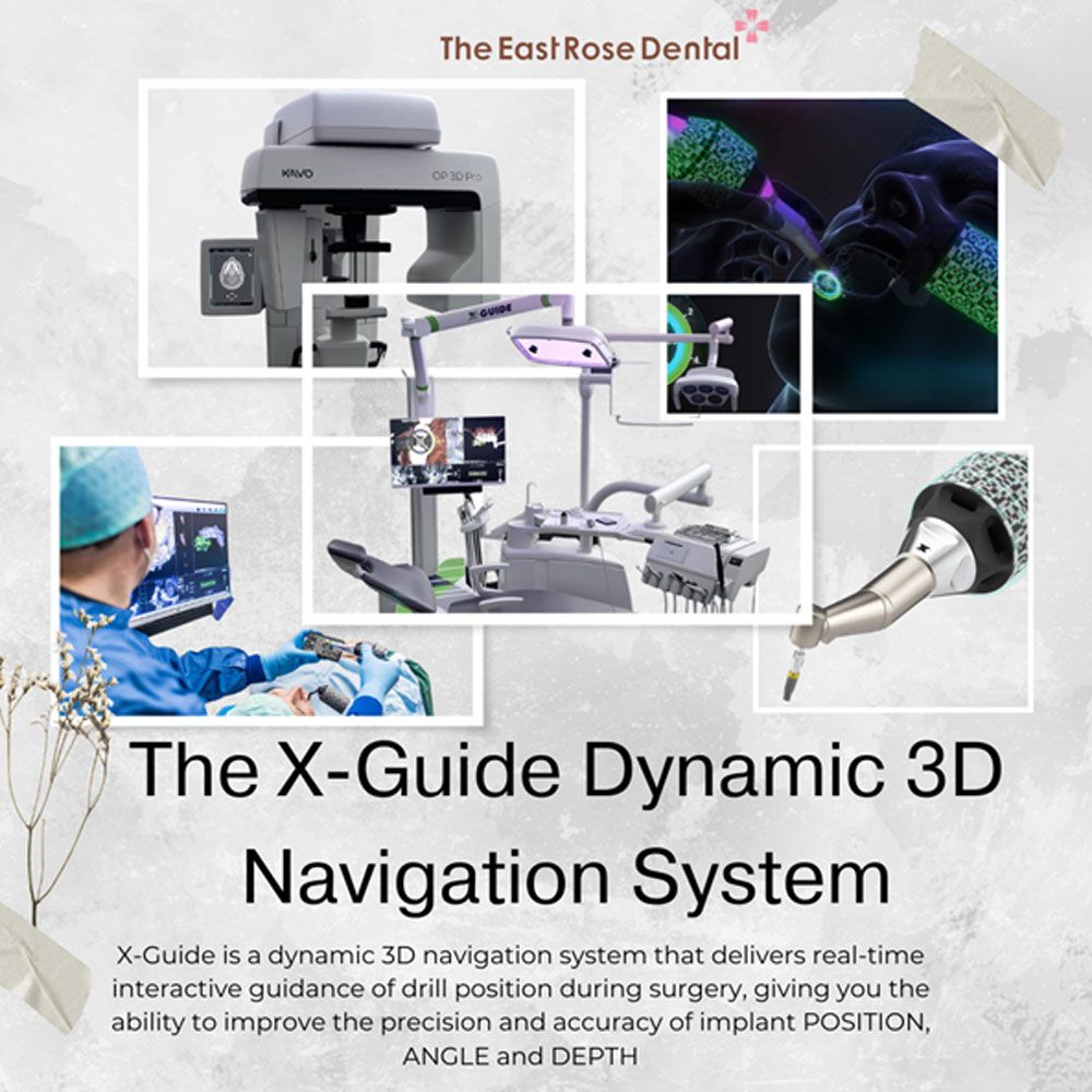 X-GUIDE - CÔNG NGHỆ TIÊN PHONG TRONG CẤY GHÉP IMPLANT
