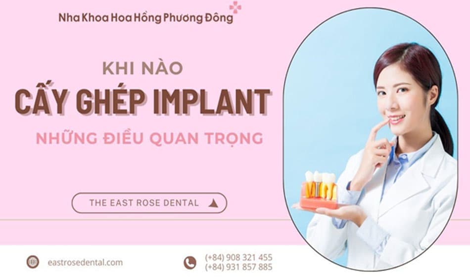 Khi nào cần cấy ghép implant? Những điều kiện quan trọng 