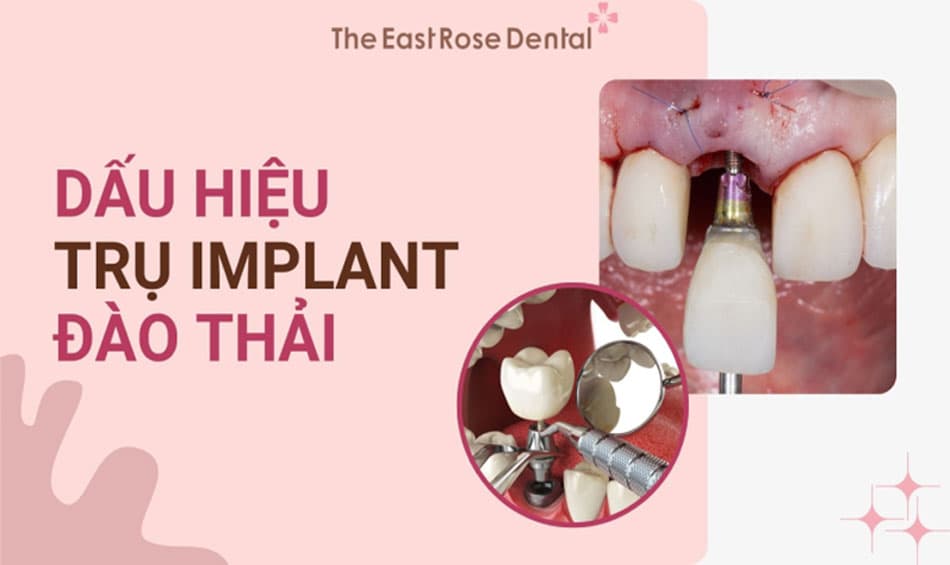 4 Dấu hiệu trụ implant bị đào thải - Nguyên nhân và giải pháp khắc phục