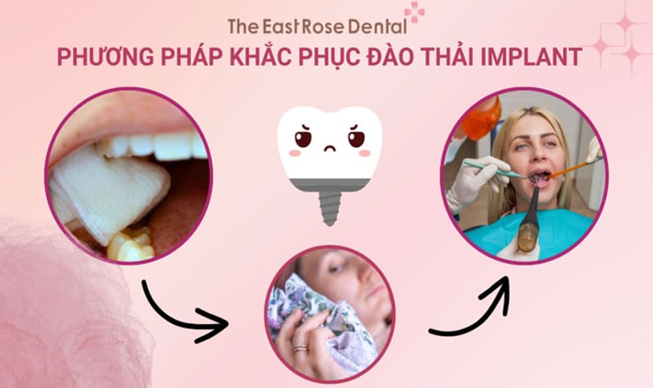Phương pháp khắc phục vấn đề đào thải trụ implant