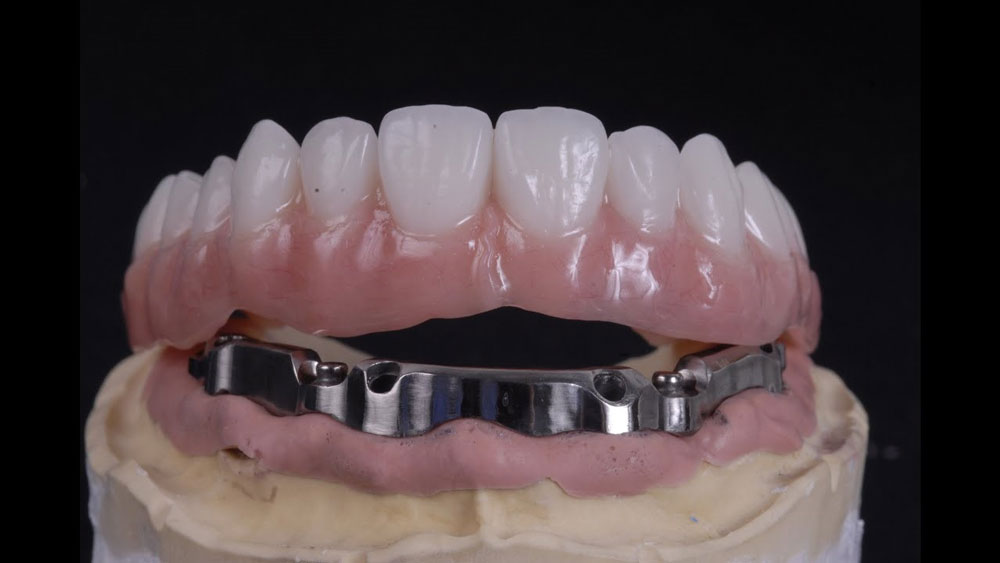 all on 4 prosthetics can be mentioned is the plastic jaw on the bar