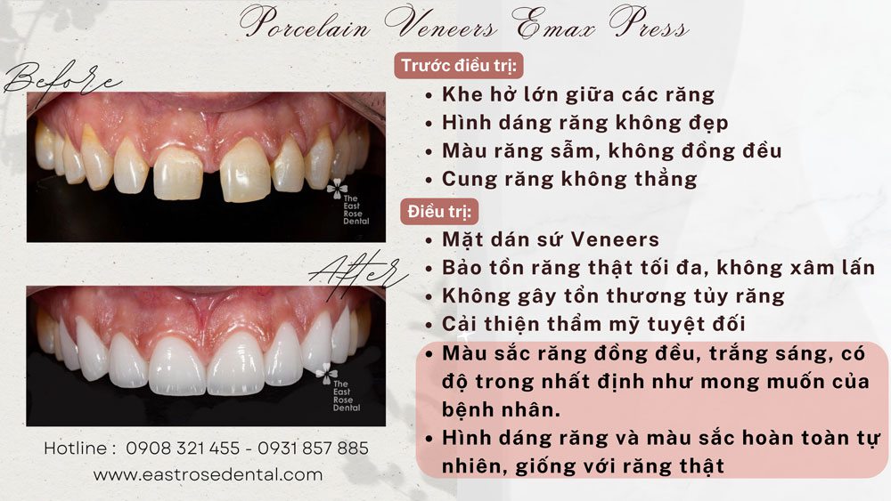 mặt dán sứ tại Nha Khoa Hoa Hồng Phương Đông