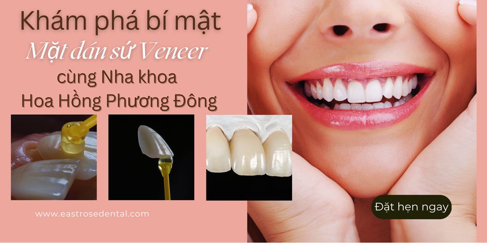 Khám phá Bí Mật của Veneer: Ưu điểm và Hạn chế được tiết lộ!
