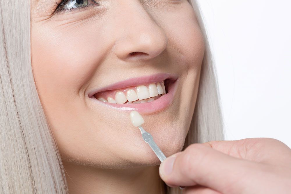 How much is dental veneer?