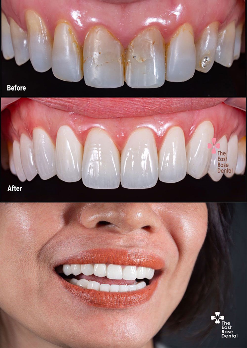 Case trước sau mắt dán sứ Veneer của chị L