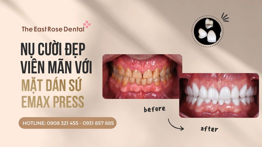 Veneer emax press cases  by The East Rose Dental Clinic