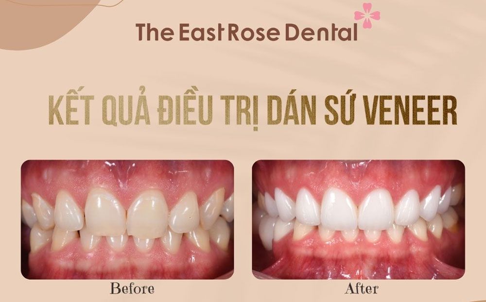 case nha khoa sử dụng mặt dán sứ Veneer cho khách hàng tại Nha Khoa Hoa hồng Phương Đông