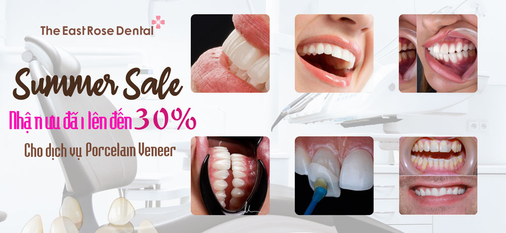 Chào hè 2023, nhận ngay ưu đãi 30% khi sử dụng dịch vụ mặt dán sứ Verneer tại Nha Khoa Hoa Hồng Phương Đông