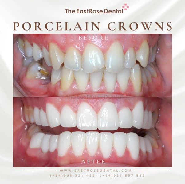 Preserving natural teeth is a significant benefit of zirconia full ceramic crowns