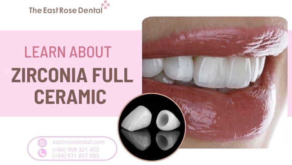Full ceramic zirconia teeth and implementation cost