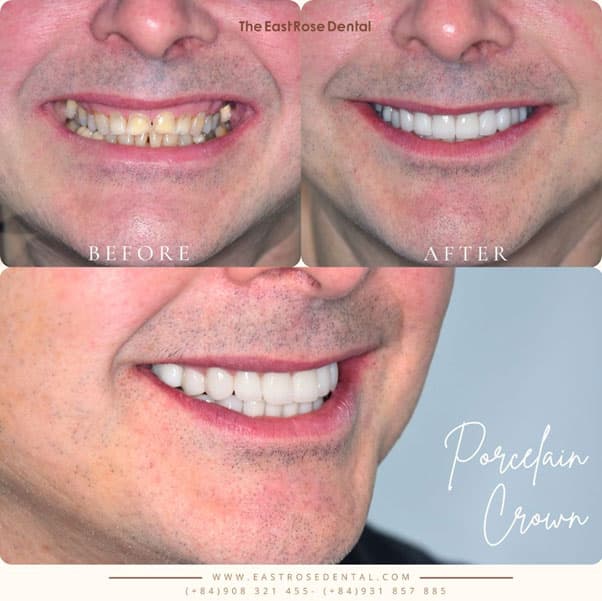 Zirconia crown results at The East Rose Dental Clinic