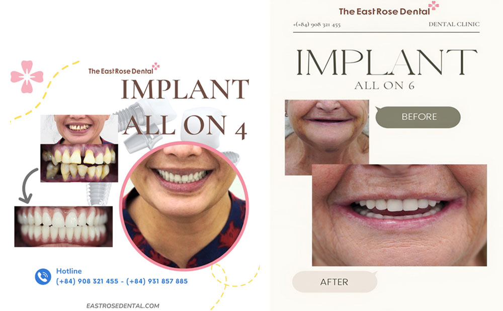 How much does it cost for performing Implant ALL ON 4 ?