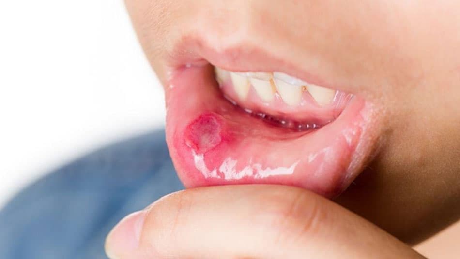 Stress negatively affects the immune system in the oral cavity