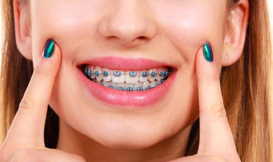 Phương pháp niềng răng mắc cài kim loại cho răng bọc sứ.