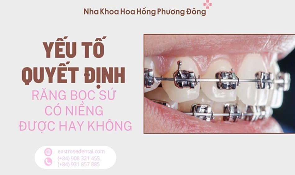 Yếu tố ảnh hưởng đến tính khả thi của việc niềng răng sau khi bọc sứ
