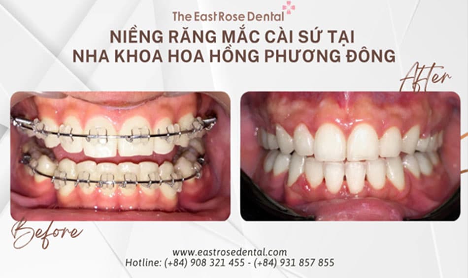 Kết quả niềng răng mắc cài sứ tại Nha Khoa Hoa Hồng Phương Đông