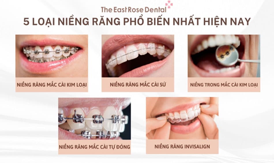 Những loại niềng răng phổ biến nhất hiện nay