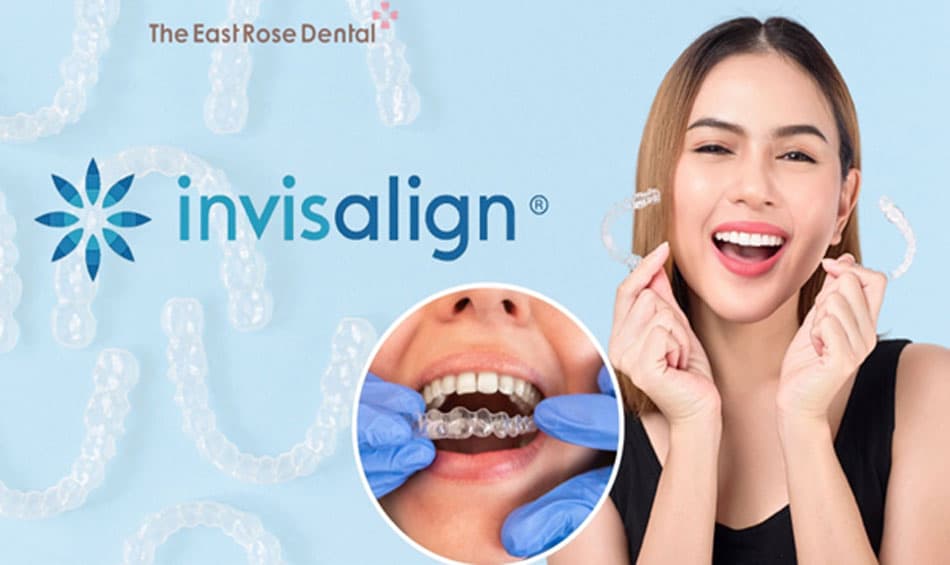 Niềng răng không mắc cài Invisalign