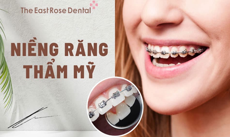 Lợi ích niềng răng thẩm mỹ và các loại niềng răng phổ biến
