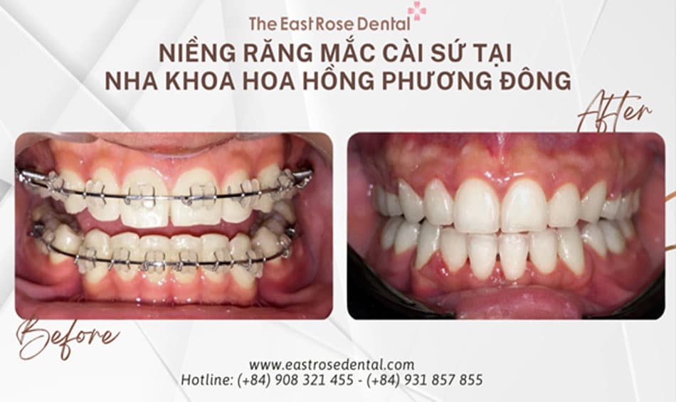 Kết quả niềng răng mắc cài sứ tại Nha Khoa Hoa Hồng Phương Đông