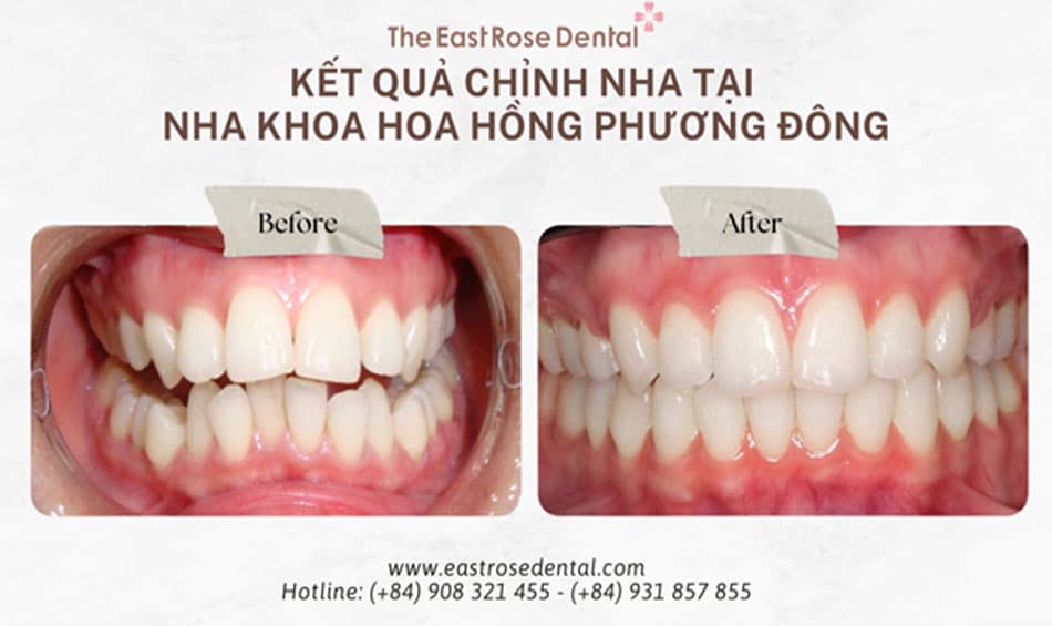 Kết quả niềng răng tại Nha Khoa Hoa Hồng Phương Đông 