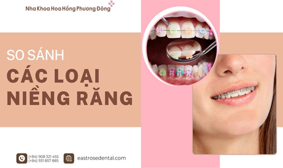 So sánh các loại niềng răng được ưa chuộng nhất hiện nay
