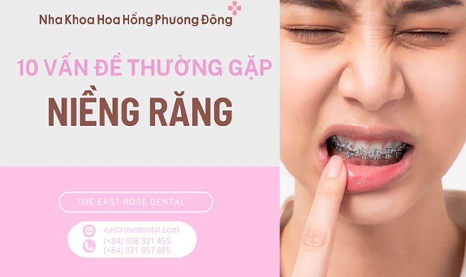 10 vấn đề thường gặp khi niềng răng và cách khắc phục hiệu quả