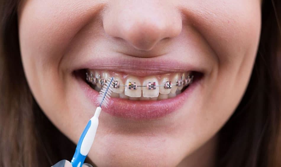 Interdental brushes provide superior cleaning effectiveness