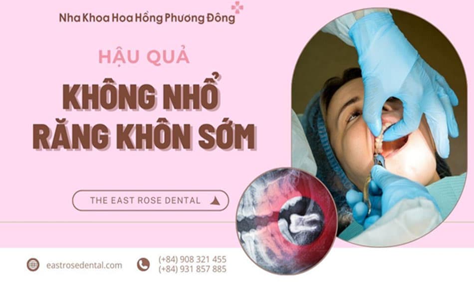 Khi nào cần nhổ răng khôn và hệ quả khi không nhổ răng khôn sớm