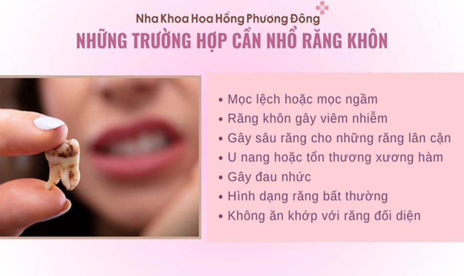 Những trường hợp cần nhổ răng khôn 