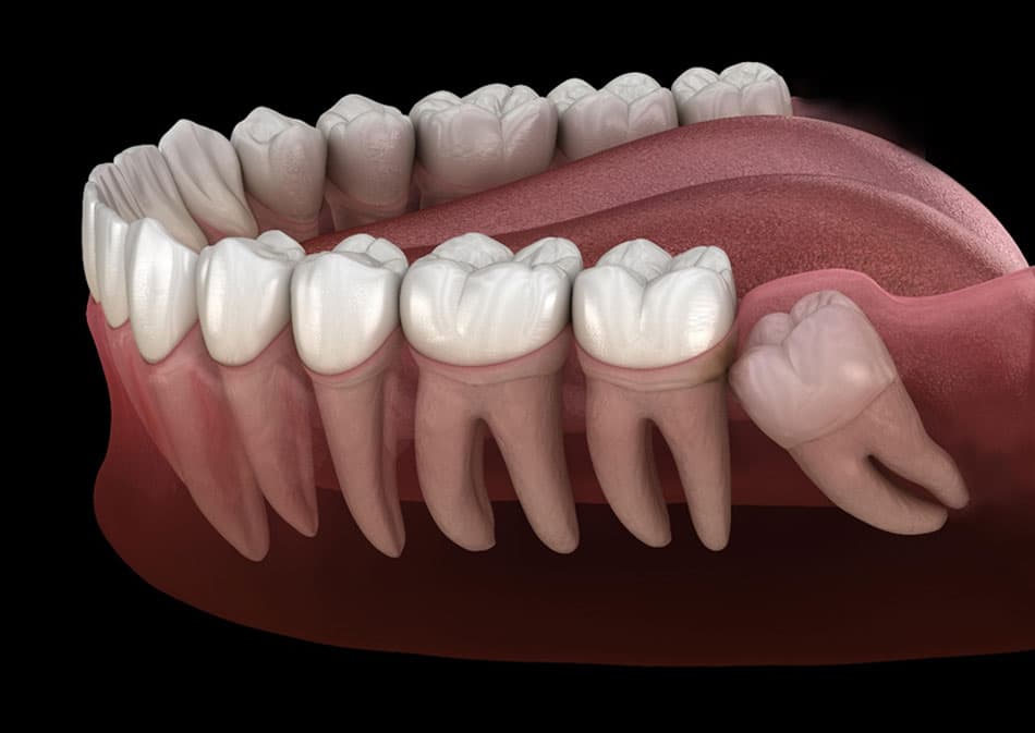 Extracting impacted teeth and notes