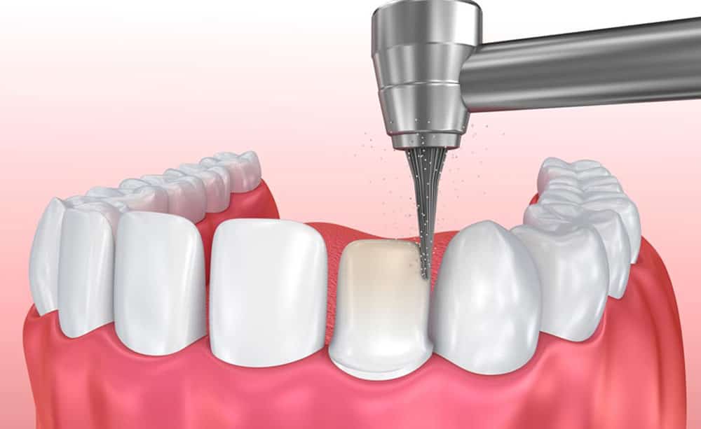 What is tooth grinding?