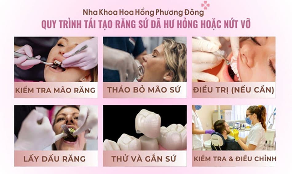 Quy trình tái tạo răng sứ hư hỏng hoặc nứt vỡ